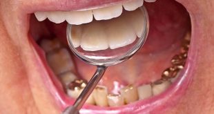 Can You Eat With Your Grillz On