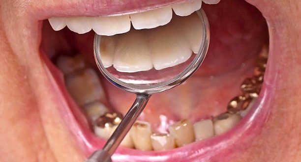 Can You Eat With Your Grillz On