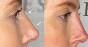 Liquid Rhinoplasty: A Non-Surgical Option for Subtle, Balanced Nose Enhancement