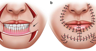 Lip Reconstruction: How Surgeons Restore Speech, Eating, and Natural Facial Expression